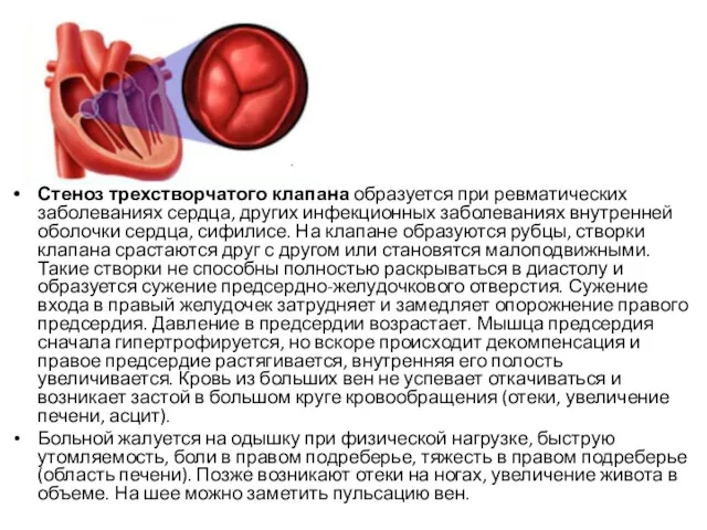 Стеноз трехстворчатого клапана образуется при ревматических заболеваниях сердца, других инфекционных