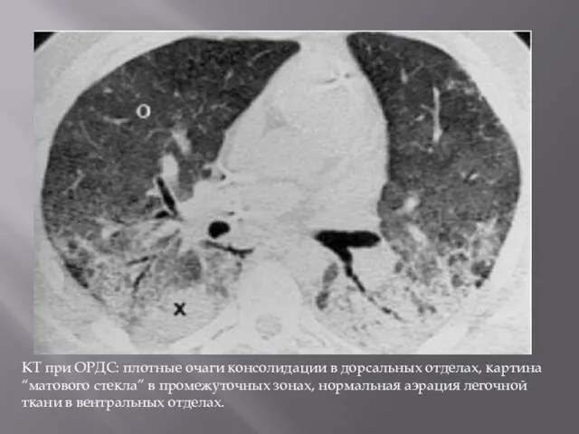 КТ при ОРДС: плотные очаги консолидации в дорсальных отделах, картина