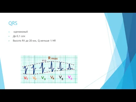 QRS одинаковый До 0,1 сек Высота RII до 20 мм, Q меньше 1/4R