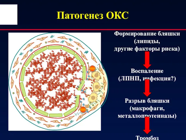 Патогенез ОКС Формирование бляшки (липиды, другие факторы риска) Воспаление (ЛПНП, инфекция?) Разрыв бляшки (макрофаги, металлопротеиназы) Тромбоз