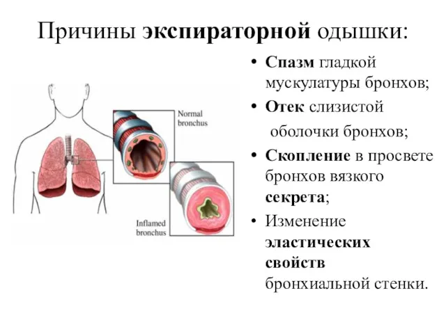 Причины экспираторной одышки: Спазм гладкой мускулатуры бронхов; Отек слизистой оболочки