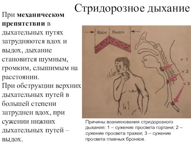 Стридорозное дыхание При механическом препятствии в дыхательных путях затрудняются вдох