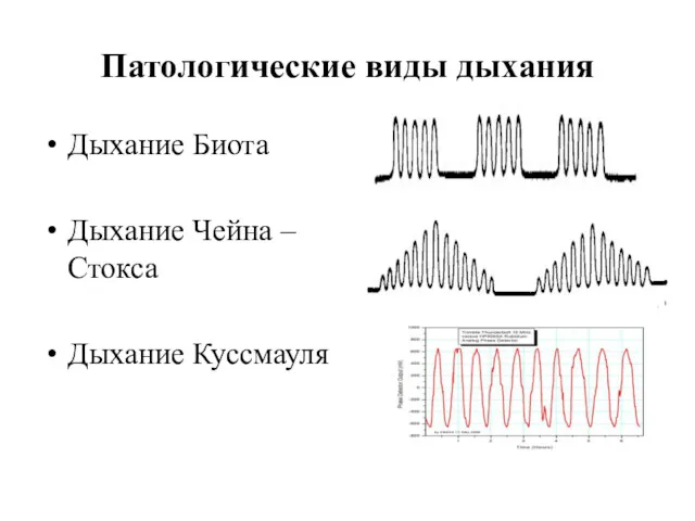 Патологические виды дыхания Дыхание Биота Дыхание Чейна –Стокса Дыхание Куссмауля