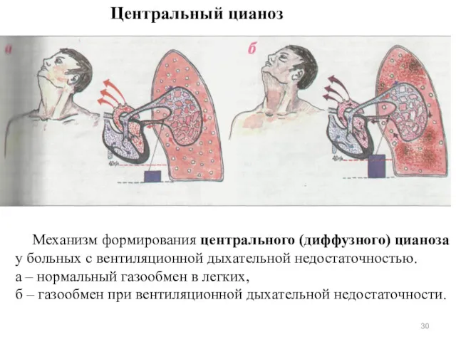 Механизм формирования центрального (диффузного) цианоза у больных с вентиляционной дыхательной