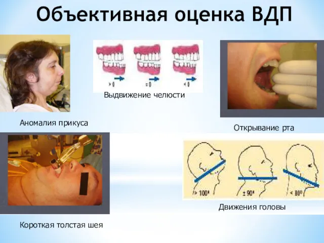 Объективная оценка ВДП Аномалия прикуса Выдвижение челюсти Открывание рта Движения головы Короткая толстая шея