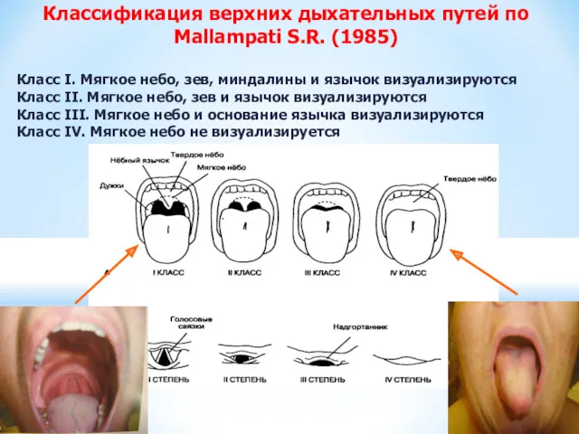 Классификация верхних дыхательных путей по Mallampati S.R. (1985) Класс I. Мягкое небо, зев,