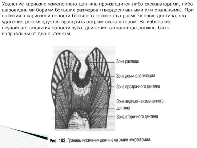 Удаление кариозно измененного дентина производится либо экскаваторами, либо шаровидными борами