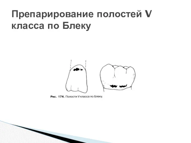 Препарирование полостей V класса по Блеку