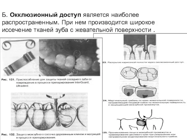 Б. Окклюзионный доступ является наиболее распространенным. При нем производится широкое