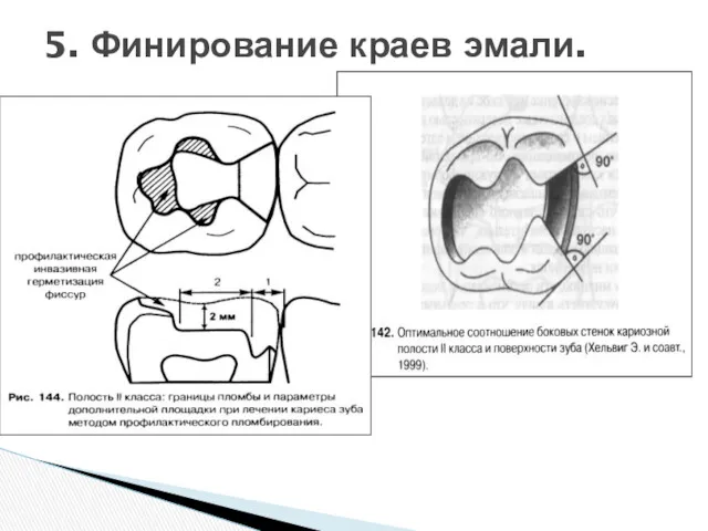 5. Финирование краев эмали.