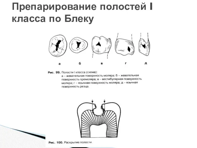 Препарирование полостей I класса по Блеку