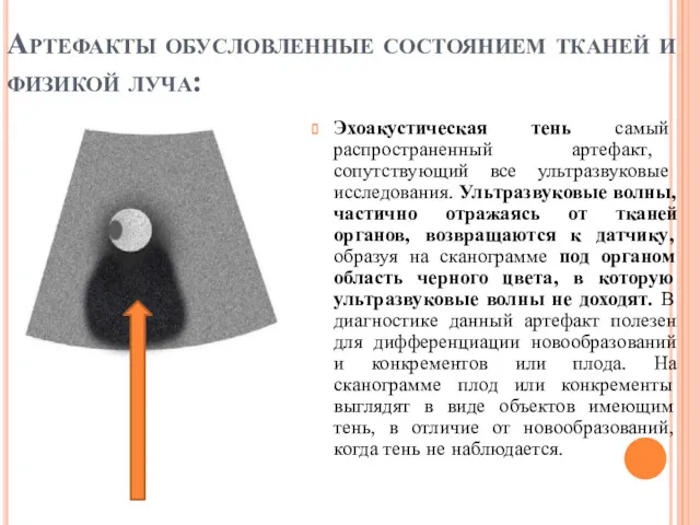 Артефакты обусловленные состоянием тканей и физикой луча: Эхоакустическая тень самый распространенный артефакт, сопутствующий