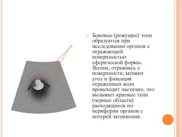 Боковые (режущие) тени образуются при исследовании органов с отражающей поверхностью сферической формы. Волны,