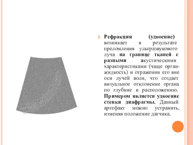 Рефракция (удвоение) возникает в результате преломления ультразвукового луча на границе тканей с разными