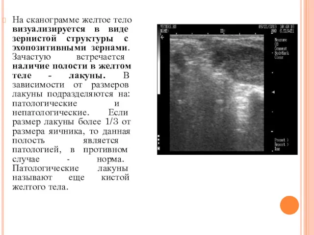 На сканограмме желтое тело визуализируется в виде зернистой структуры с эхопозитивными зернами. Зачастую