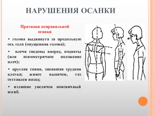 Признаки неправильной осанки • голова выдвинута за продольную ось тела