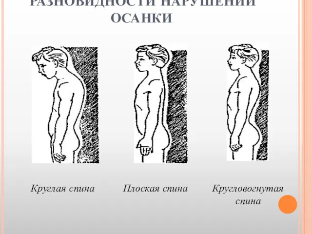 РАЗНОВИДНОСТИ НАРУШЕНИЙ ОСАНКИ Круглая спина Кругловогнутая спина Плоская спина