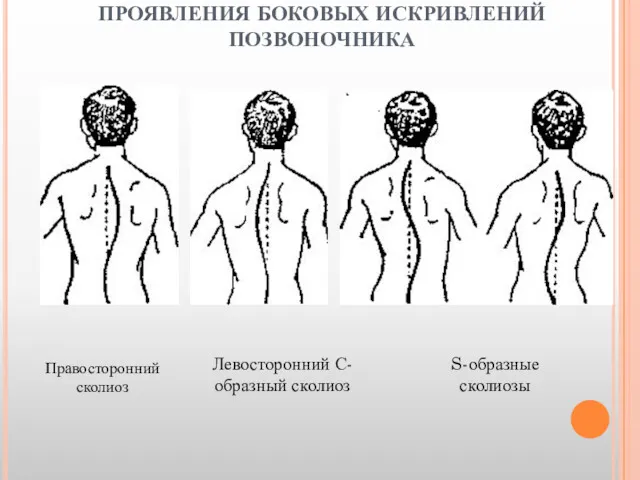 ПРОЯВЛЕНИЯ БОКОВЫХ ИСКРИВЛЕНИЙ ПОЗВОНОЧНИКА Правосторонний сколиоз Левосторонний С-образный сколиоз S-образные сколиозы