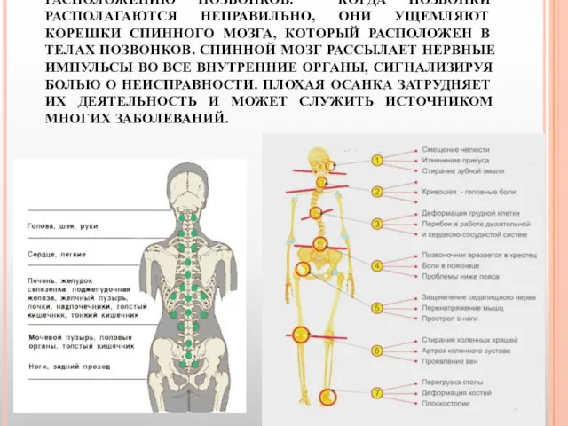 НЕПРАВИЛЬНАЯ ОСАНКА ПРИВОДИТ К НЕПРАВИЛЬНОМУ РАСПОЛОЖЕНИЮ ПОЗВОНКОВ. КОГДА ПОЗВОНКИ РАСПОЛАГАЮТСЯ