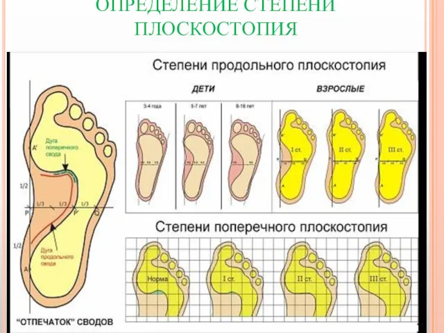 ОПРЕДЕЛЕНИЕ СТЕПЕНИ ПЛОСКОСТОПИЯ