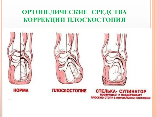 ОРТОПЕДИЧЕСКИЕ СРЕДСТВА КОРРЕКЦИИ ПЛОСКОСТОПИЯ