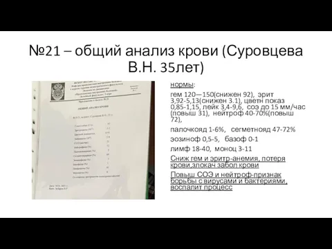 №21 – общий анализ крови (Суровцева В.Н. 35лет) нормы: гем