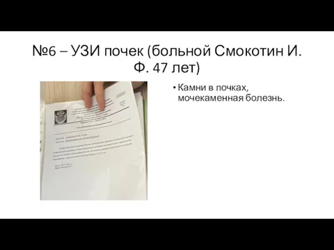 №6 – УЗИ почек (больной Смокотин И.Ф. 47 лет) Камни в почках, мочекаменная болезнь.