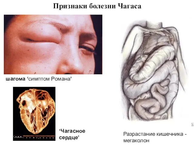Признаки болезни Чагаса Разрастание кишечника - мегаколон шагома ‘симптом Романа’ ‘Чагасное сердце’
