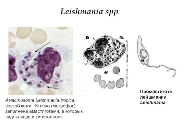 Leishmania spp. Амастигота Leishmania tropica, соскоб кожи. Клетка (макрофаг) заполнена
