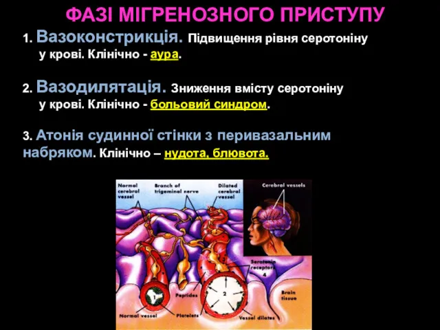 ФАЗІ МІГРЕНОЗНОГО ПРИСТУПУ 1. Вазоконстрикція. Підвищення рівня серотоніну у крові.