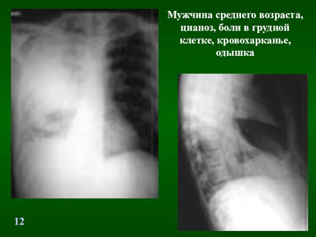 Мужчина среднего возраста, цианоз, боли в грудной клетке, кровохарканье, одышка 12