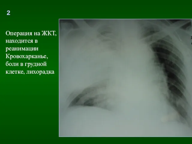 2 Операция на ЖКТ, находится в реанимации Кровохарканье, боли в грудной клетке, лихорадка