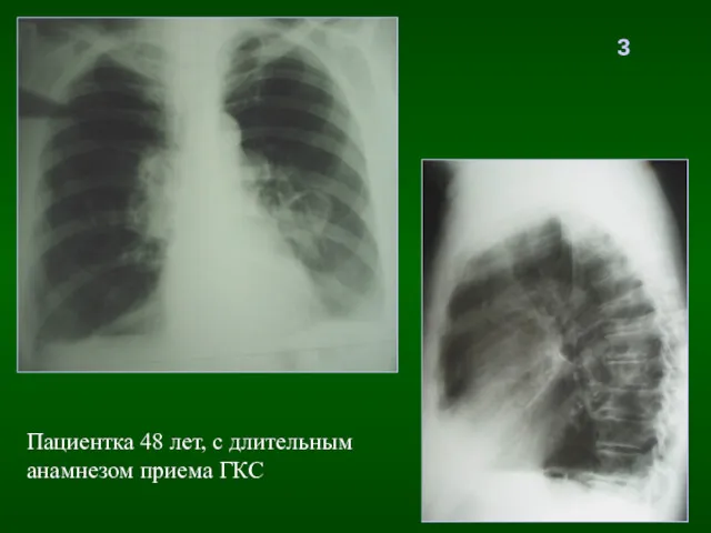 3 Пациентка 48 лет, с длительным анамнезом приема ГКС