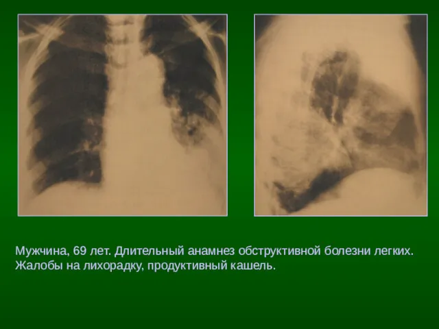 Мужчина, 69 лет. Длительный анамнез обструктивной болезни легких. Жалобы на лихорадку, продуктивный кашель.