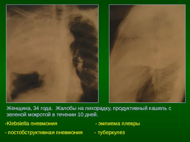 Женщина, 34 года. Жалобы на лихорадку, продуктивный кашель с зеленой