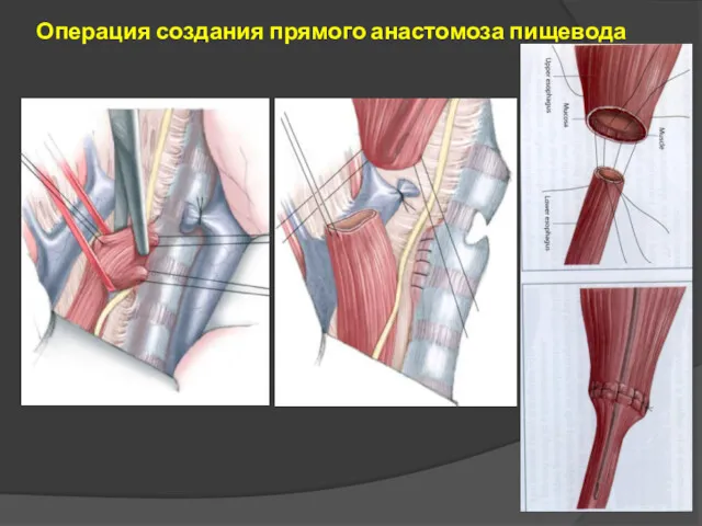 Операция создания прямого анастомоза пищевода