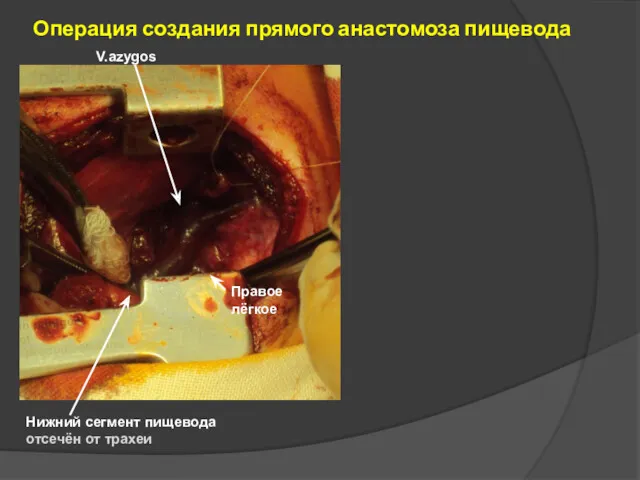 Операция создания прямого анастомоза пищевода Нижний сегмент пищевода отсечён от трахеи V.azygos Правое лёгкое