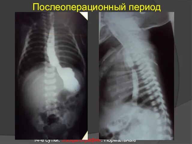 Послеоперационный период 14-е сутки. Эзофагография. Нормальные снимки