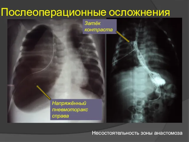 Послеоперационные осложнения Несостоятельность зоны анастомоза Напряжённый пневмоторакс справа Затёк контраста