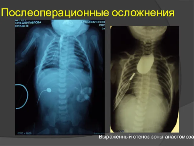 Послеоперационные осложнения Выраженный стеноз зоны анастомоза