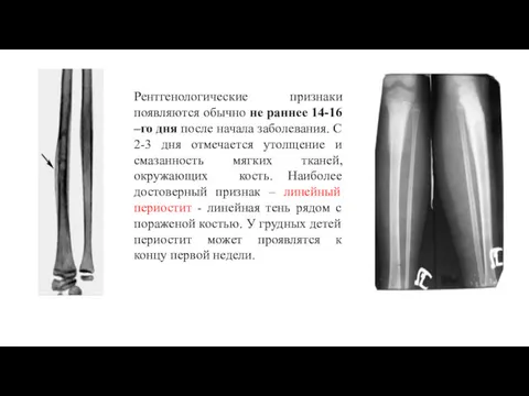 Рентгенологические признаки появляются обычно не раннее 14-16 –го дня после