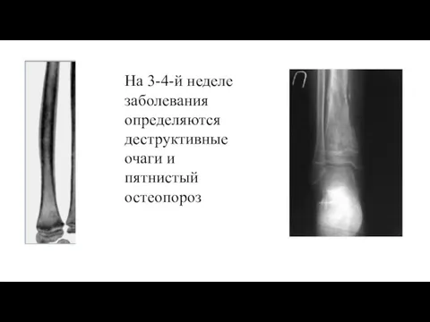 На 3-4-й неделе заболевания определяются деструктивные очаги и пятнистый остеопороз