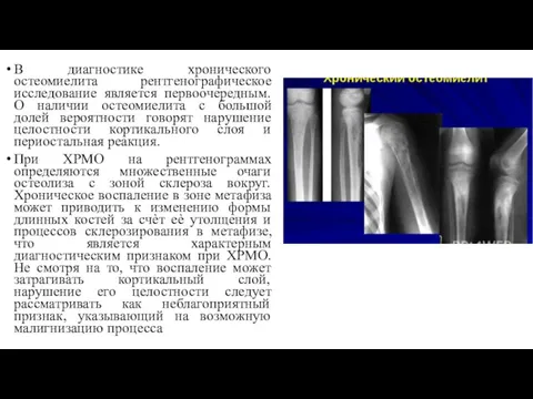 В диагностике хронического остеомиелита рентгенографическое исследование является первоочередным. О наличии