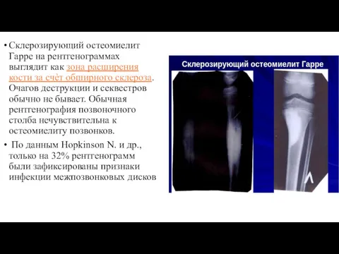 Склерозирующий остеомиелит Гарре на рентгенограммах выглядит как зона расширения кости