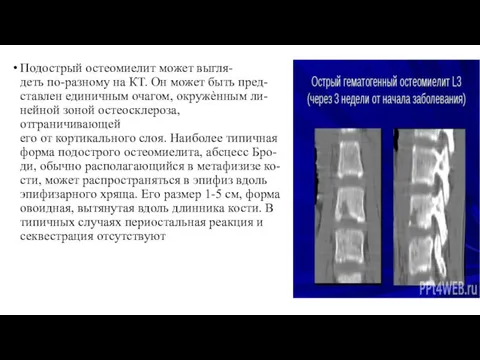 Подострый остеомиелит может выгля- деть по-разному на КТ. Он может