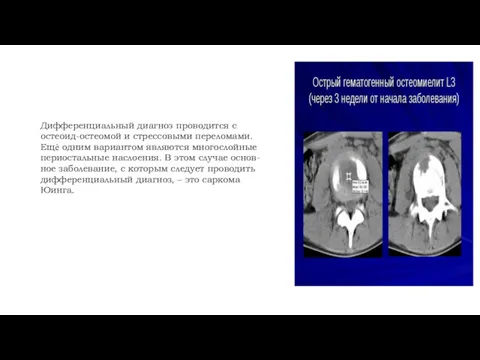 Дифференциальный диагноз проводится с остеоид-остеомой и стрессовыми переломами. Ещѐ одним