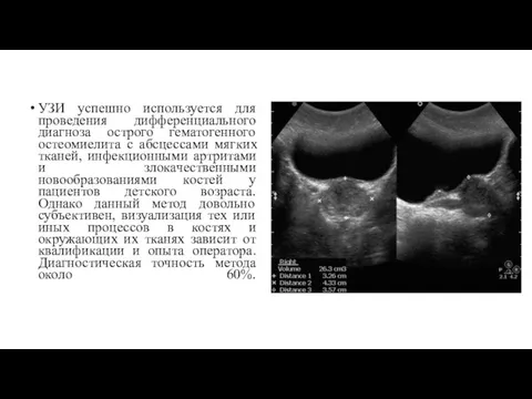 УЗИ успешно используется для проведения дифференциального диагноза острого гематогенного остеомиелита