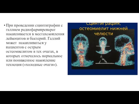 При проведении сцинтиграфии с галлием радиофармпрепарат накапливается в местахскопления лейкоцитов