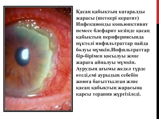 Қасаң қабықтың катаралды жарасы (шеткері кератит) Инфекционды коньюнктивит немесе блефарит