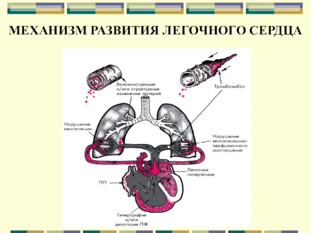 МЕХАНИЗМ РАЗВИТИЯ ЛЕГОЧНОГО СЕРДЦА